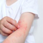 allergies in children