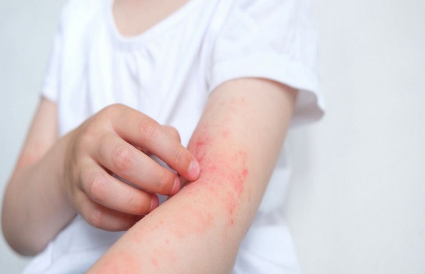 allergies in children